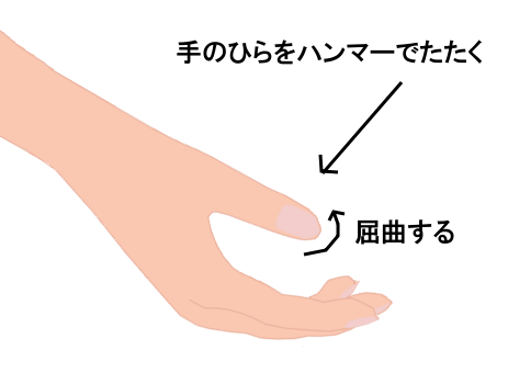 病的反射・ワルテンベルクの図